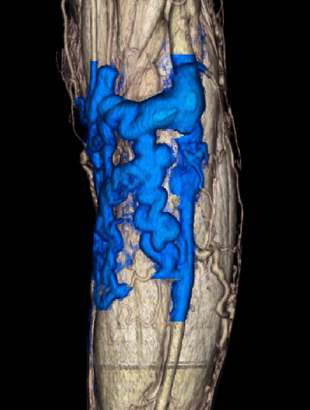 下肢静脈瘤の症状2